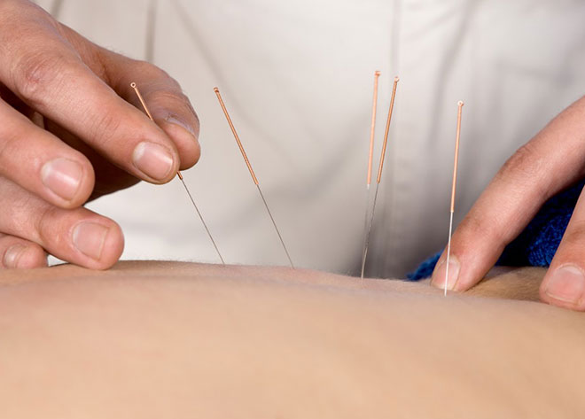 Dry Needling 01