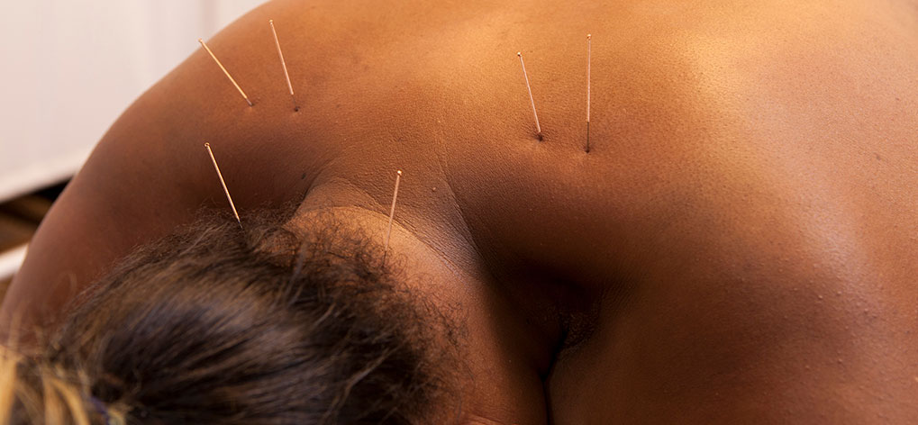 Dry Needling 02