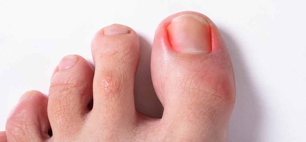 Ingrown Toenail Management