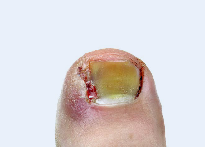 Ingrown Toenail Management 01