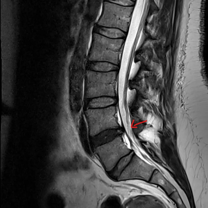 Disc Bulge Pressing On Sciatic Nerve Causing Lower Back Pain 1