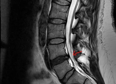 Disc Bulge Pressing On Sciatic Nerve Causing Lower Back Pain