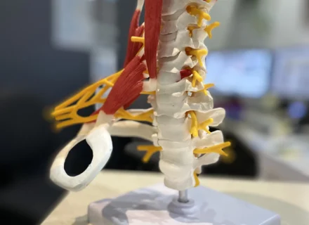 A cervical radiculopathy is a pinched nerve in the neck coming from a disc bulge