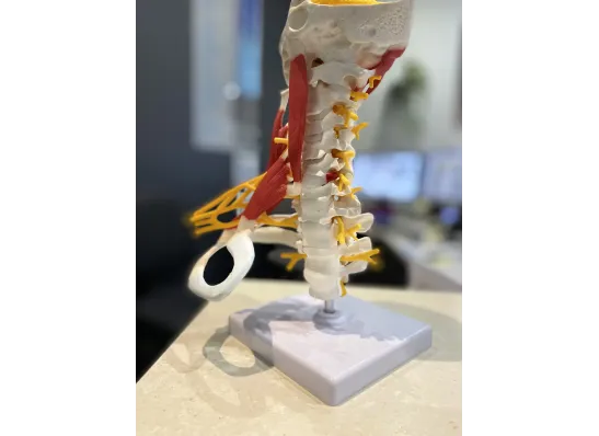 A cervical radiculopathy is a pinched nerve in the neck coming from a disc bulge