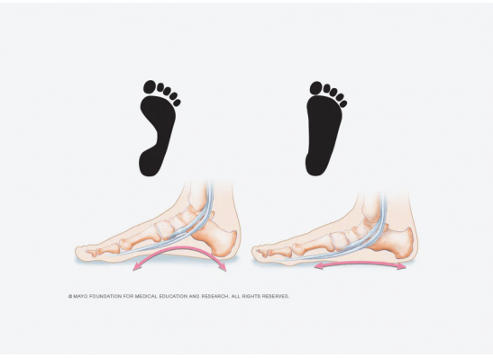 Can A Podiatrist Fix Flat Feet