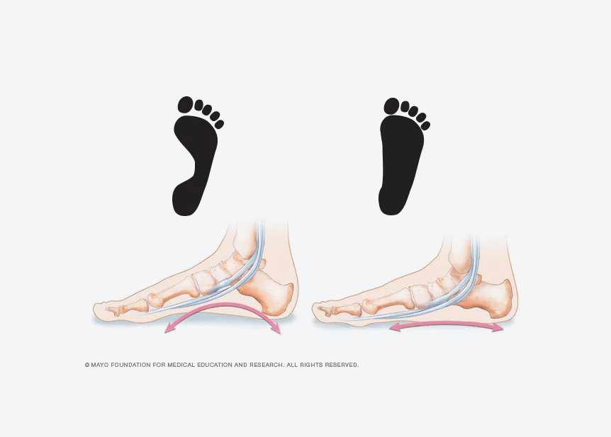Can A Podiatrist Fix Flat Feet