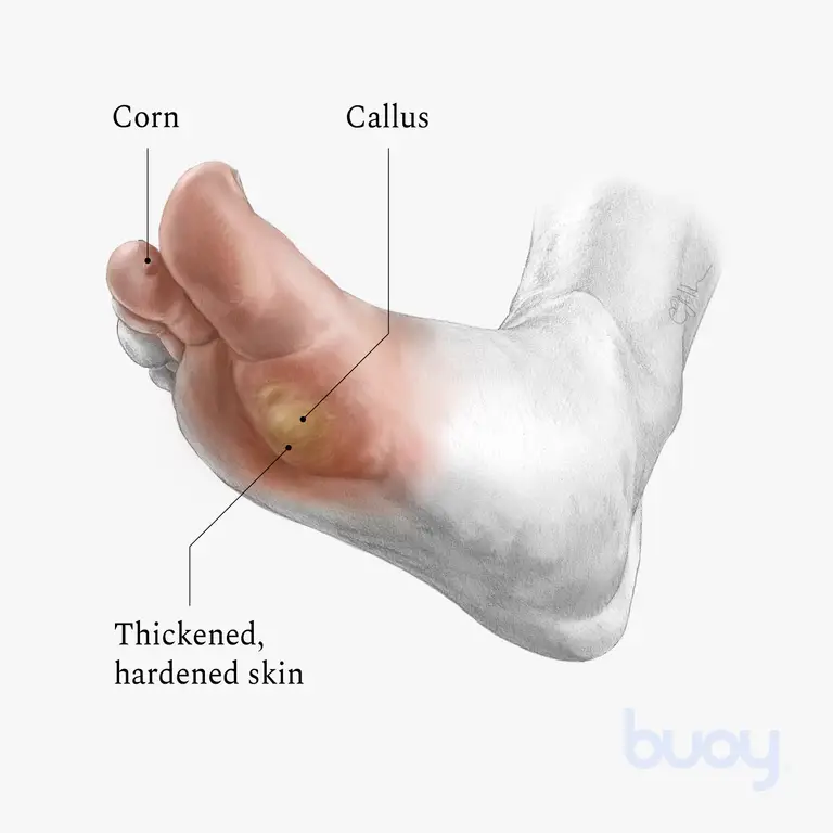 Foot corns and calluses