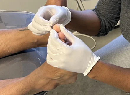 Corn Removal By A Podiatrist
