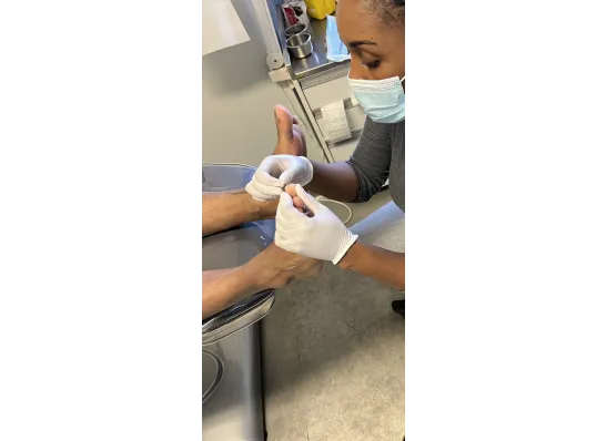 Corn Removal By A Podiatrist