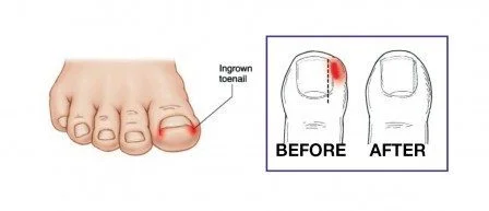 Ingrown toenail surgery