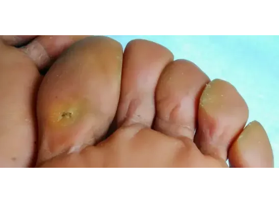 Foot Corns