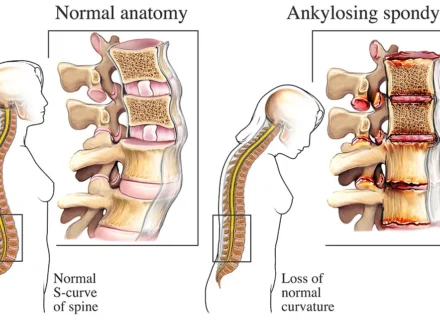 Ankylosing Spondylitis