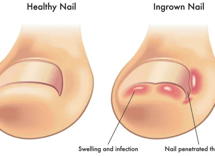 Ingrown toenail