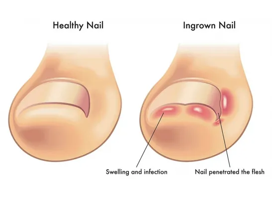 Ingrown toenail