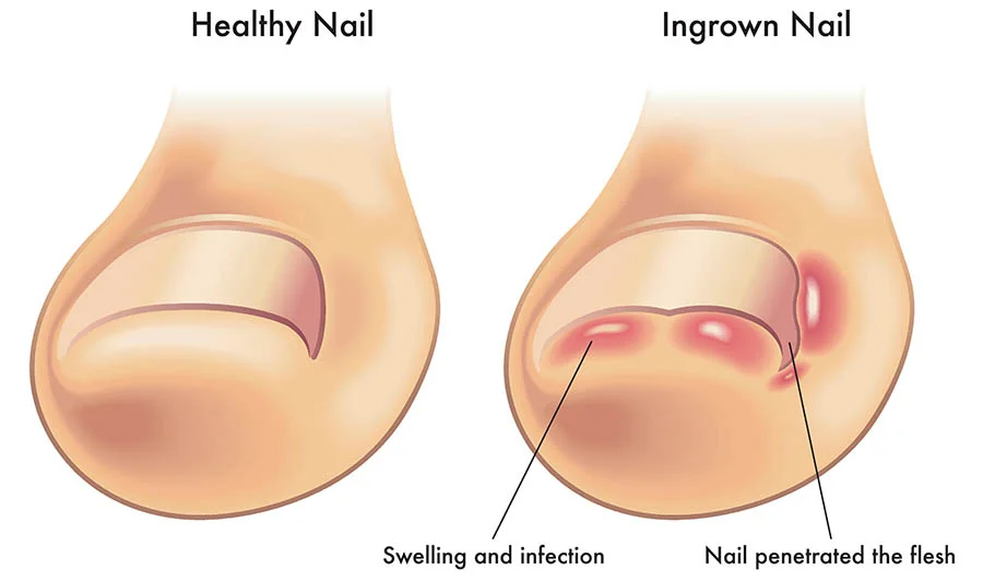 Nail Surgery - Ingrown Toenail Surgery | Toenail Removal Service