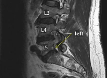 Lower Back Degeneration physio