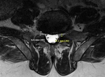Spinal Stenosis Lower Back And Neck Pain