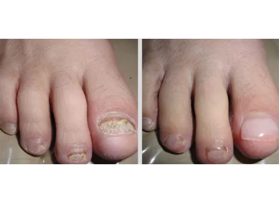 Before And After Kery Flex Restoration (1)