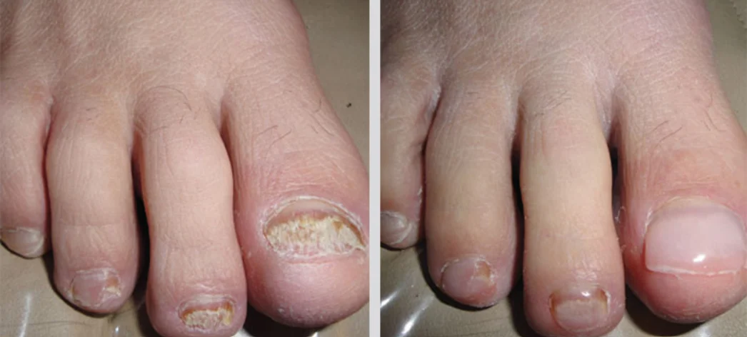 Before And After Kery Flex Restoration (1) Before And After Kery Flex Restoration (1)