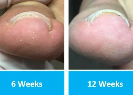 Onyfix Nail Correction for Ingrown Toenails