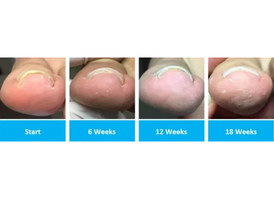 Onyfix Nail Correction for Ingrown Toenails