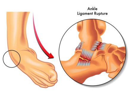 Ankle Sprain Recovery Time