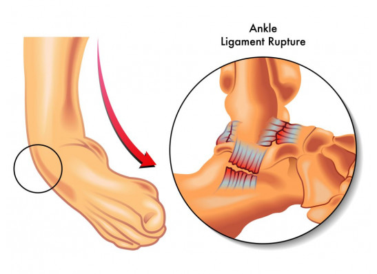 Ankle Sprain Recovery Time