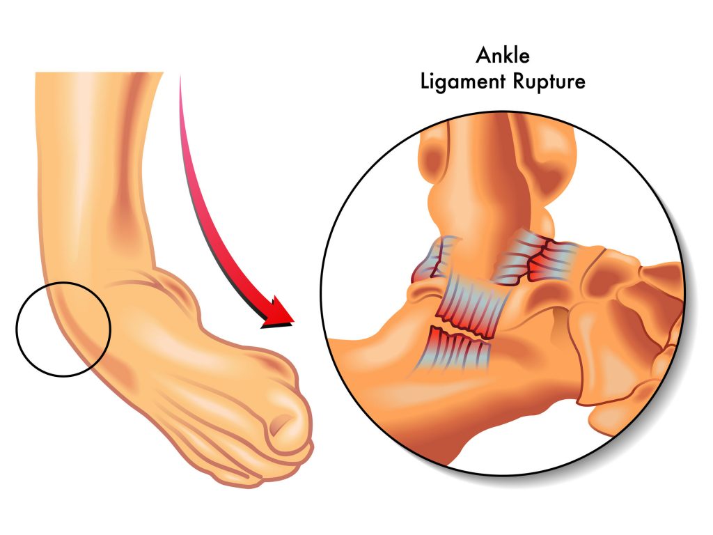 Ankle Sprain Healing Time