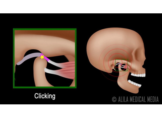 Jaw Popping (Clicking)