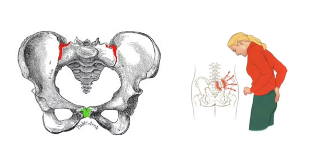 Pelvic Girdle Pain