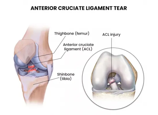Anterior Cruciate Ligament Tear