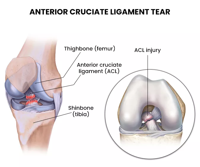 Anterior Cruciate Ligament Tear