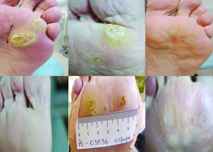 wart-swift-treatment-4