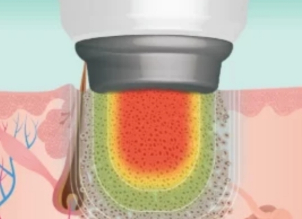 wart-swift-treatment